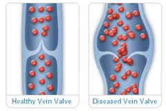 Rosen Vein 104:Pathophysiology or “Veins Gone Wild!”,Part 1