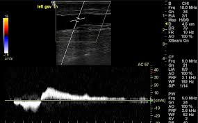 Rosen Vein Lecture 105: Diagnosis, part 2…The Ultrasound Exam