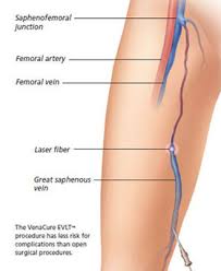 Rosen Vein Lectures: Vein Treatments, Part 2