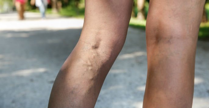 Spider veins