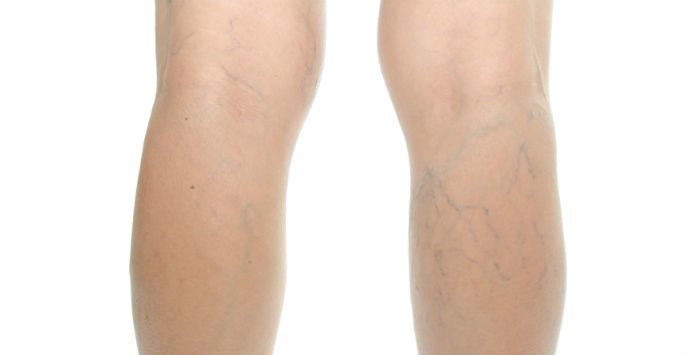 superficial venous insufficiency