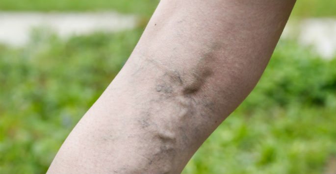 Common Causes of Spider Veins